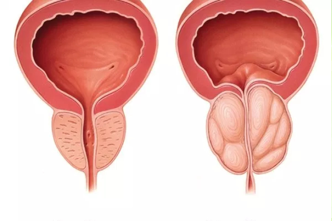 nódulo en la próstata es cáncer