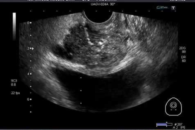 biopsia prostata resultados ecuador biopsia prostata resultados ecuador