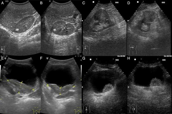benign prostatic hyperplasia ultrasound therapy