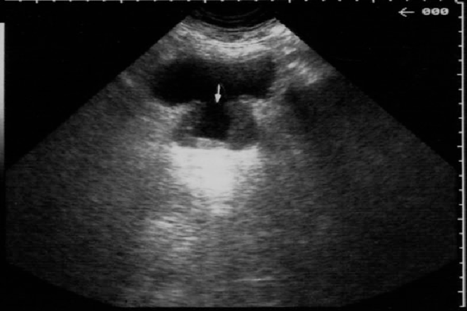 ecografia renal vesical y prostata