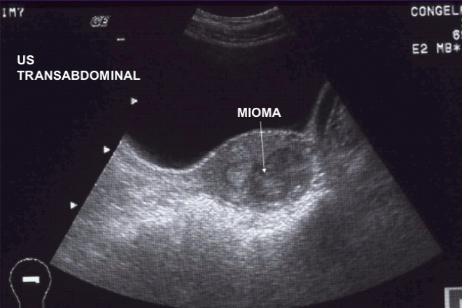 Diagnóstico Y Tratamiento De Miomatosis Uterina