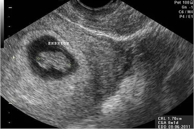 Ultrasonido en el primer trimestre del embarazo, 10 consideraciones básicas  -