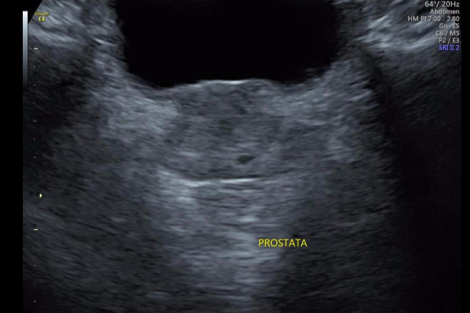 ecografia pelvica prostata băi de terebentină pentru tratamentul prostatitei