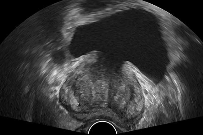 ecografia prostata adenoma