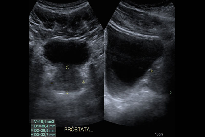 Que es prostatectomia radical laparoscopica